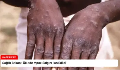 Sağlık Bakanı: Ülkede Mpox Salgını İlan Edildi