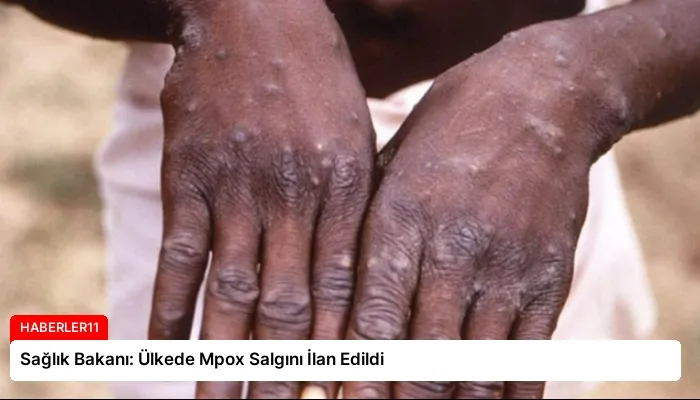 Sağlık Bakanı: Ülkede Mpox Salgını İlan Edildi