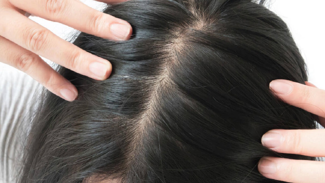 Saç Dökülmesine Karşı En Etkili Tedavi Yöntemleri (2025 Güncel)